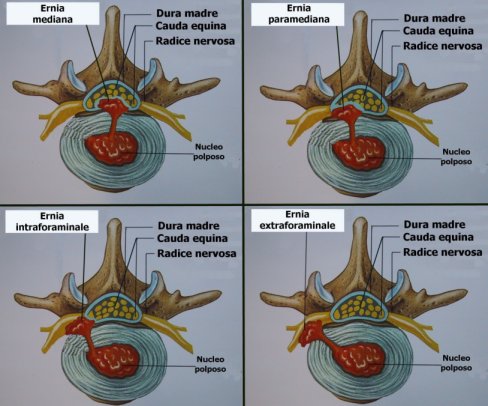 Consideraciones Sobre La Hernia Discal Lumbar Coes fisioterapia Consideraciones Sobre La Hernia Discal Lumbar Coes fisioterapia