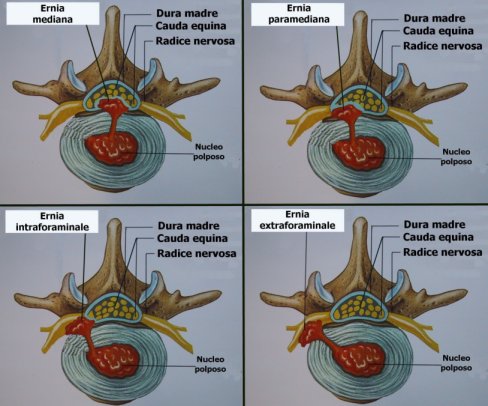 Consideraciones sobre la hernia discal lumbar